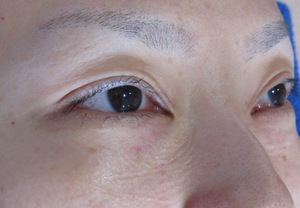 目の下のたるみ、目のくまでお悩みの方、切らずに完璧に解決します。TCB-R法　手術直後　症例写真